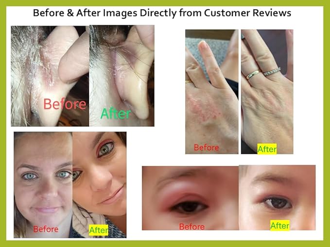 Tea Tree Oil Balm - All Natural | Great Cream for Soothing Eczema, Psoriasis, Rashes, Jock Itch, Insect Bites, Folliculitis, Acne, Itches, Cracked Heels, Cuticles, Saddle Sores & more!